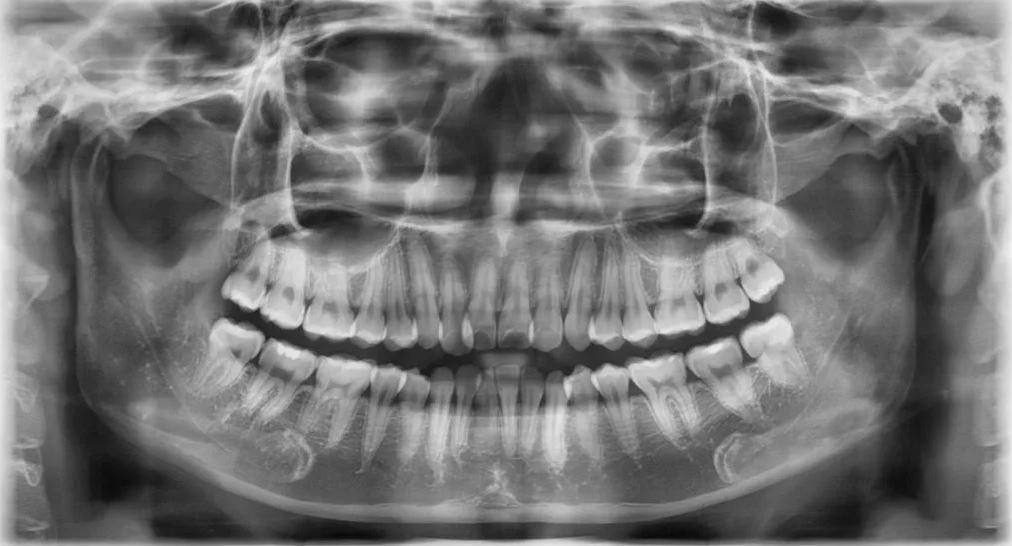 hình x-quang răng