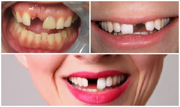 mất răng cửa có nên trồng răng implant