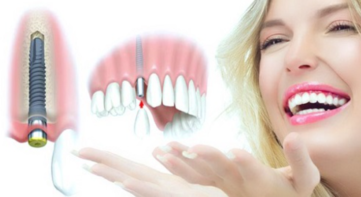 quy trình cấy ghép implant răng cửa