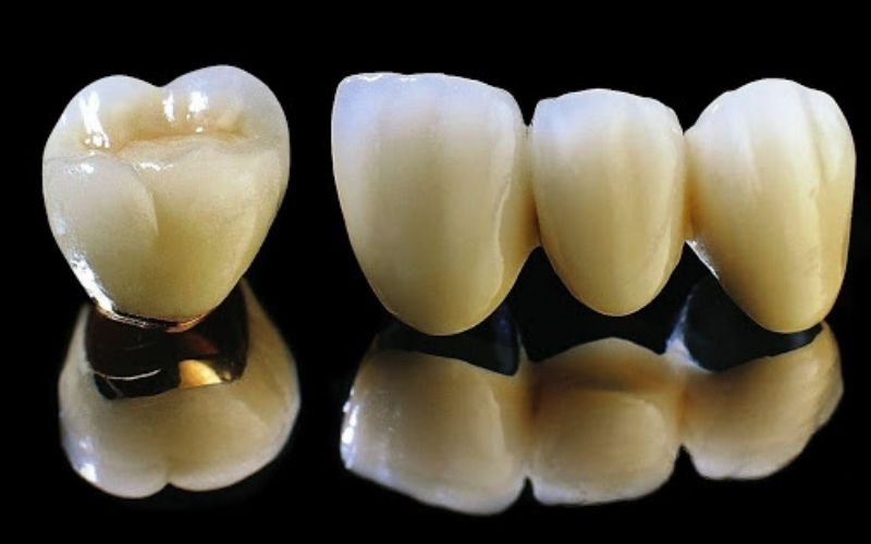 bọc răng sứ kim loại thường