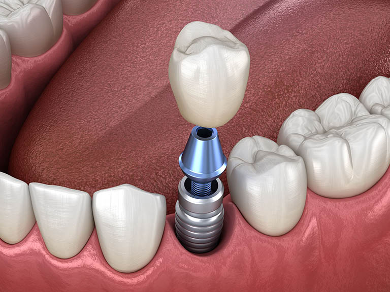 TÌM HIỂU NHỔ RĂNG BAO LÂU THÌ CẤY IMPLANT