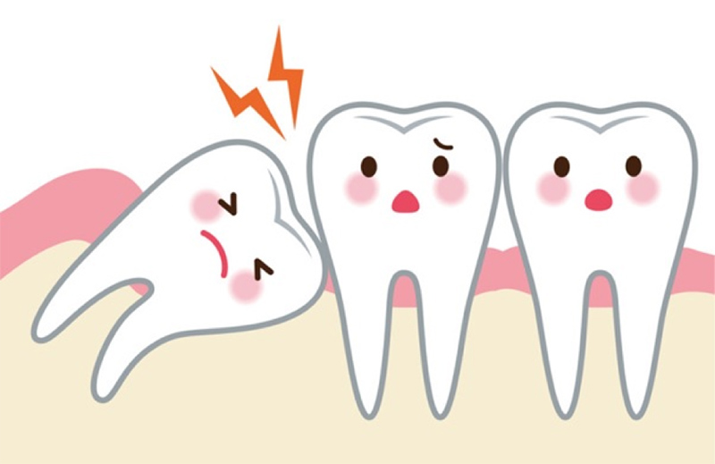 RĂNG KHÔN LÀ RĂNG SỐ MẤY? MỘT NGƯỜI CÓ MẤY CHIẾC RĂNG KHÔN?