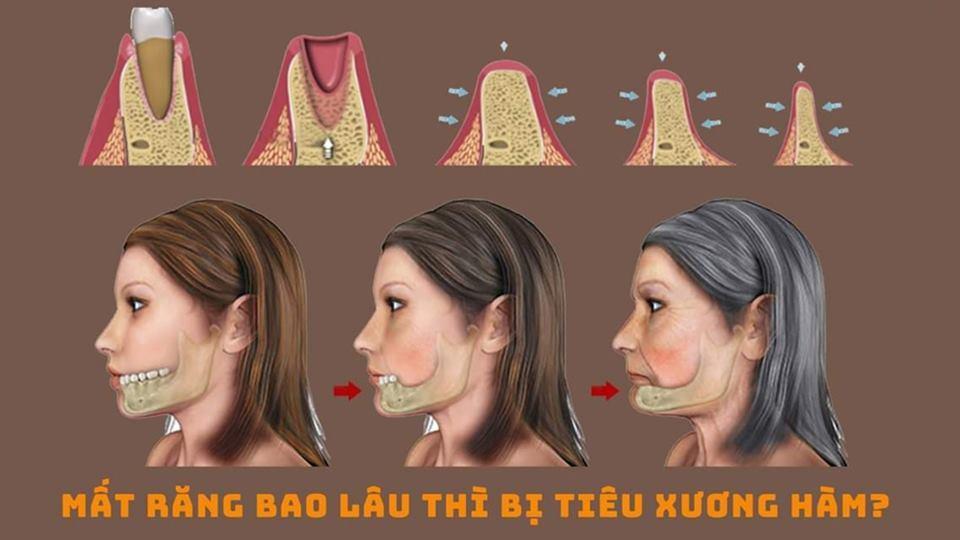 MẤT RĂNG BAO LÂU THÌ BỊ TIÊU RĂNG HÀM – PHƯƠNG PHÁP KHẮC PHỤC HIỆU QUẢ