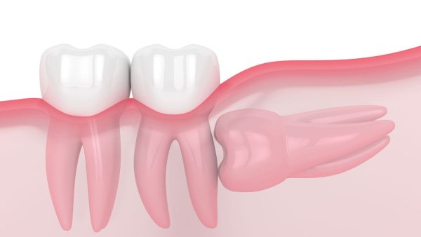 QUY TRÌNH NHỔ RĂNG KHÔN MỌC NGANG THEO TIÊU CHUẨN