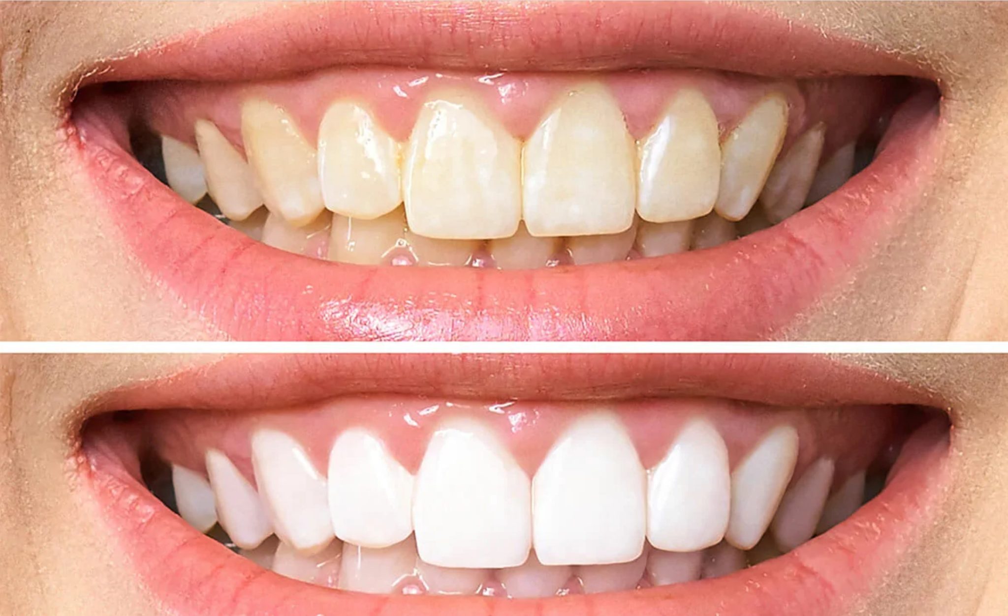 Tẩy trắng răng giữ được bao lâu