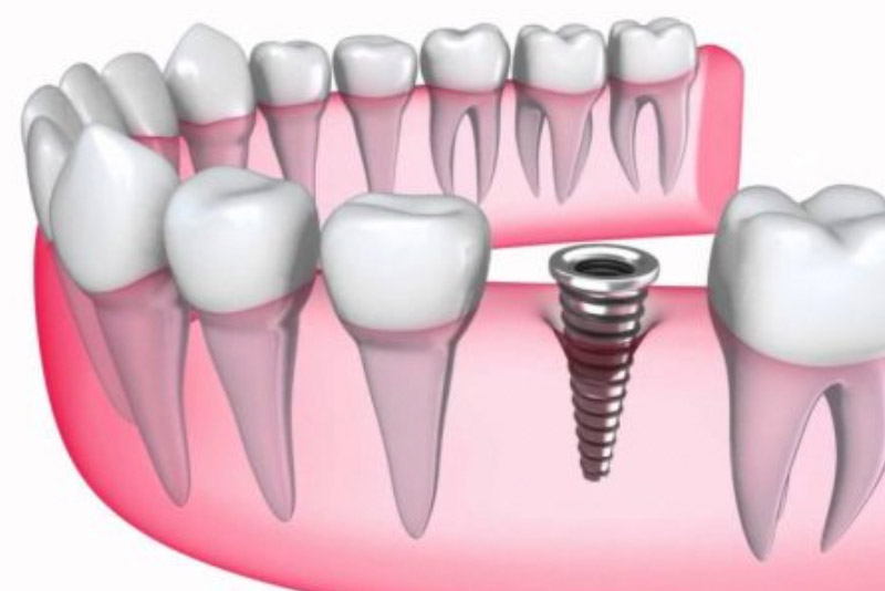 thân răng implant