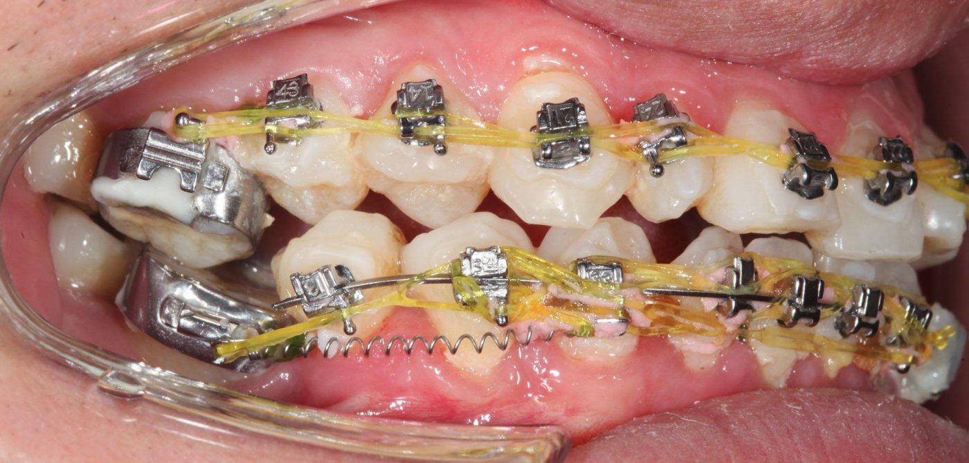 ưu điểm của kỹ thuật niềng răng không nhổ răng