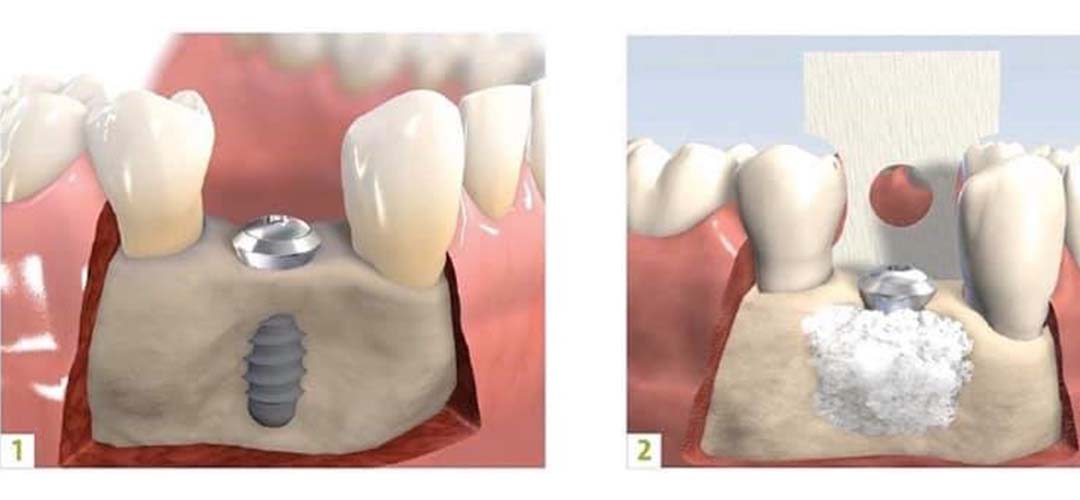 Tại sao cần phải thực hiện kỹ thuật ghép xương răng? 