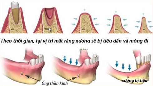 quá trình tiêu xương hàm