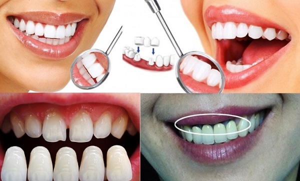 bọc răng sứ có gây hôi miệng ?