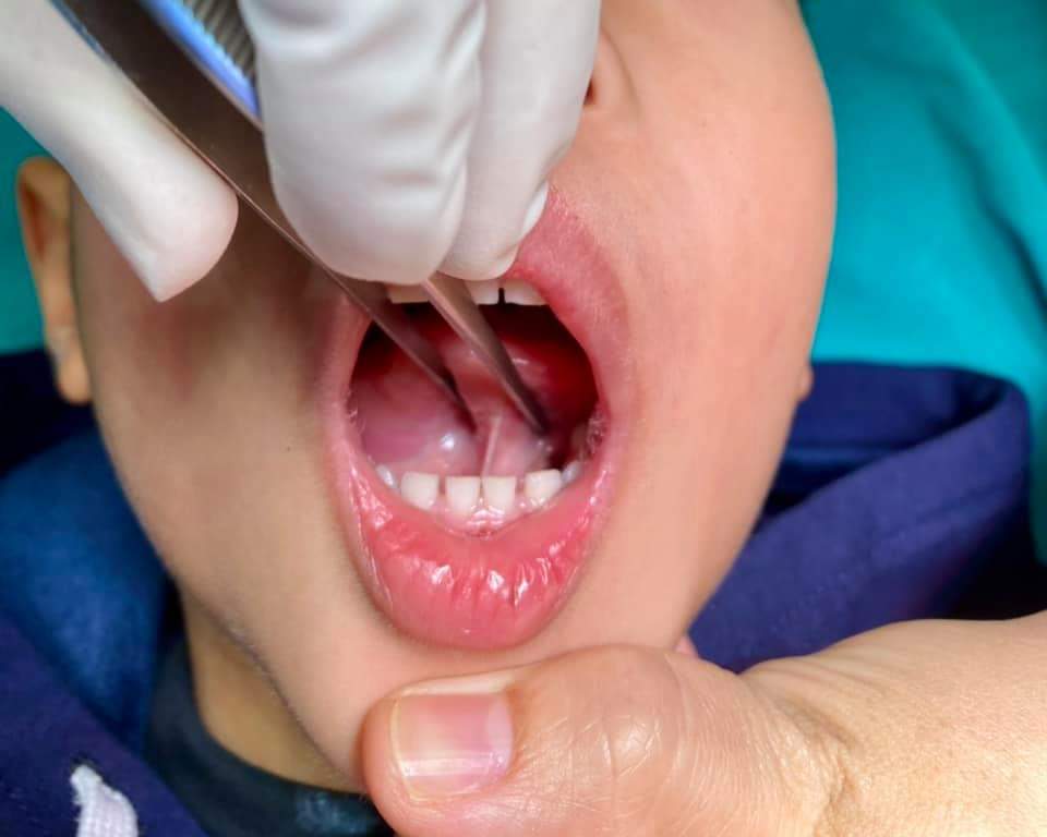 cách chăm sóc sau phẫu thuật dính phanh lưỡi