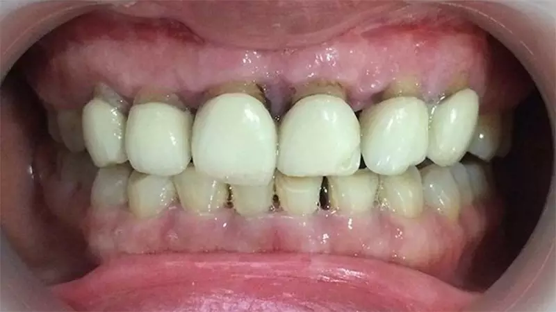 Răng sứ bị oxy hóa 