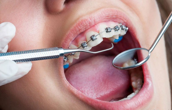 cách xử lý sâu răng trước khi niềng