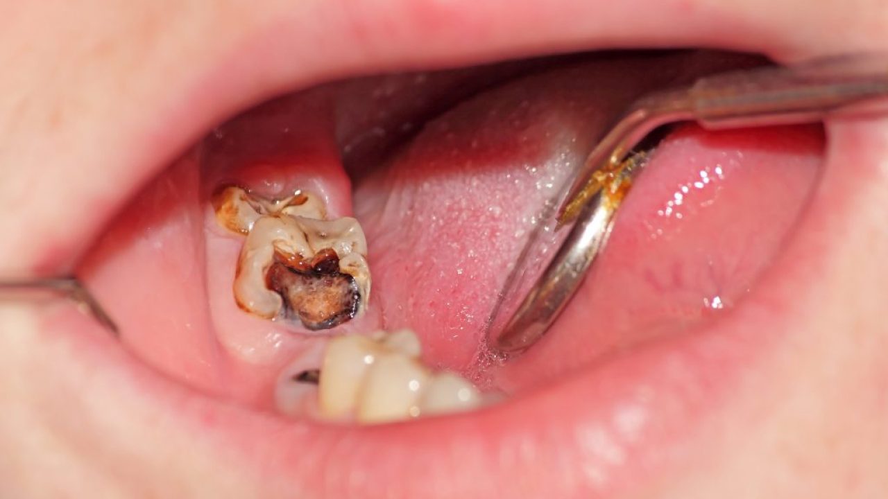 hậu quả khi lấy tủy răng không sạch 