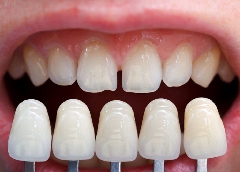 Cách điều trị răng bọc sứ lâu năm bị đau