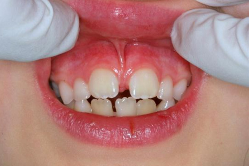 răng thưa có ảnh hưởng gì