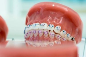 Trồng răng thì có niềng răng giả có được không?