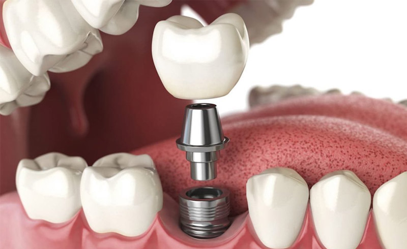 trồng răng implant 