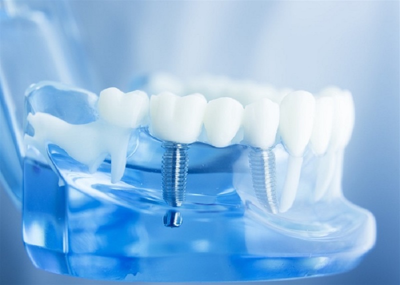 lý do nên lựa chọn trồng răng implant trả góp