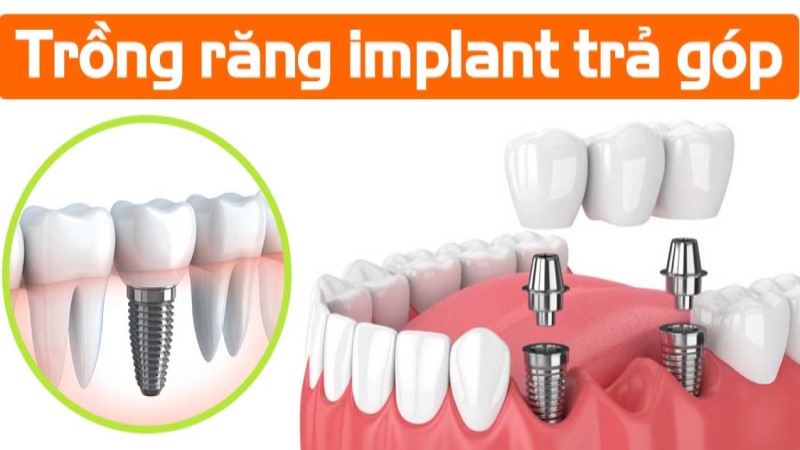 TRỒNG RĂNG IMPLANT TRẢ GÓP – GIẢI PHÁP TUYỆT VỜI CHO NỖI LO TÀI CHÍNH