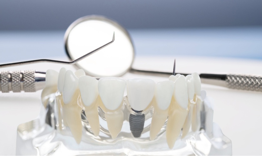 trồng răng implant là gì