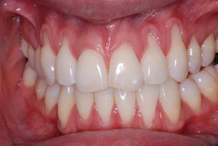 cách chăm sóc răng hiệu quả tại nhà để tránh lợi mỏng lộ chân răng 