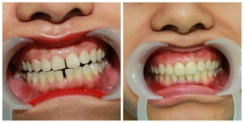 trám răng khắc phục răng thưa