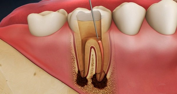 HOẠI TỬ TỦY RĂNG LÀ GÌ ? ĐIỀU TRỊ SAO CHO HIỆU QUẢ ?