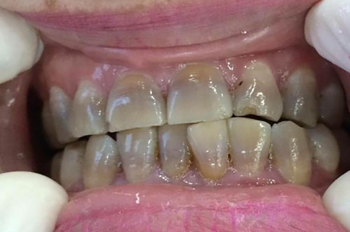 Răng bị ố do sử dụng thuốc doxycyclin hoặc tetracycline