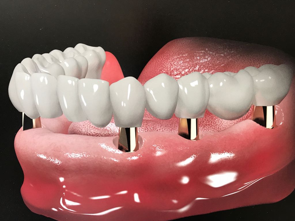 làm răng giả nguyên hàm bằng phương pháp implant