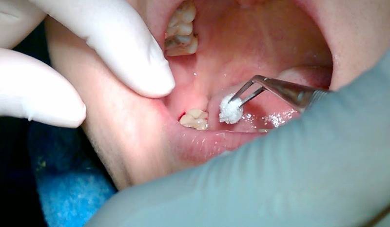 Dấu hiệu nhiễm trùng sau thời gian nhổ răng khôn