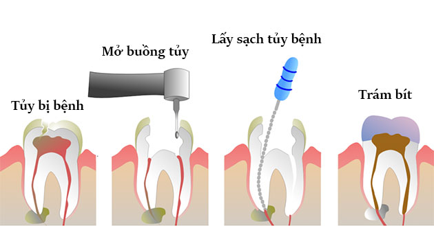 quy trình lấy tủy răng