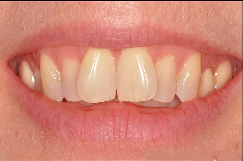 Một số khuyết điểm thường gặp ở răng cửa