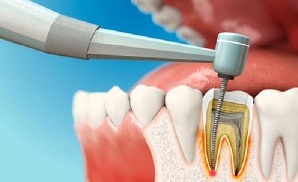 Cách chăm sóc răng sau khi lấy tủy