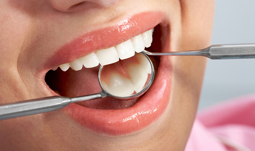 QUY TRÌNH TRÁM RĂNG THẨM MỸ TẠI NHA KHOA SEADENTAL