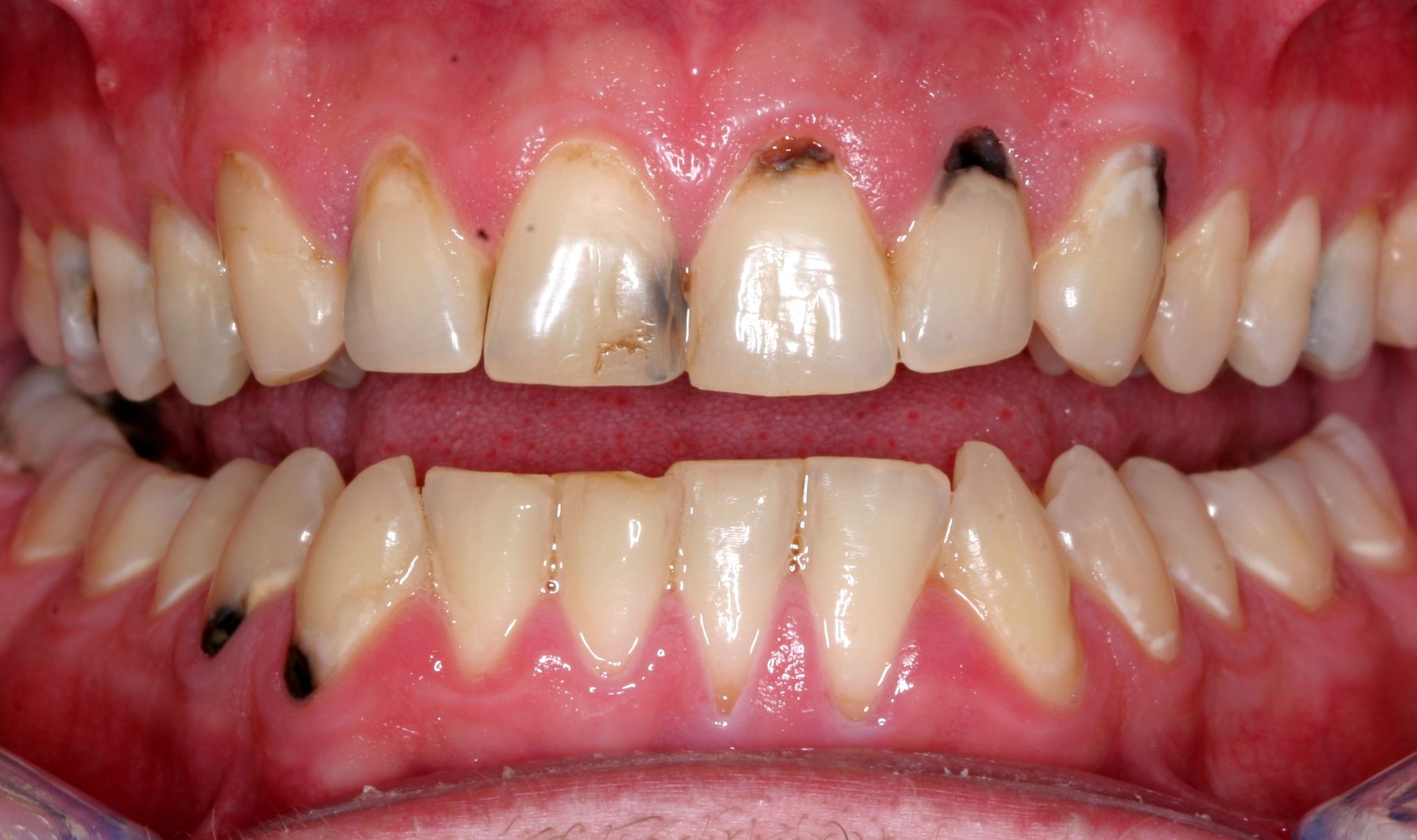 viêm lợi sau khi bọc răng 