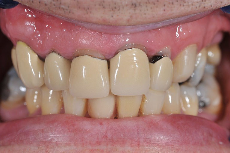 viêm lợi sau khi bọc răng có nguy hiểm không