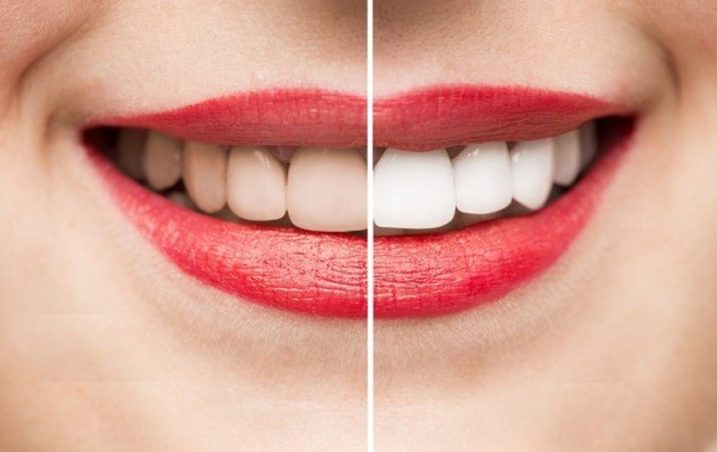 Cách để duy trì hàm răng luôn trắng sáng sau khi tẩy trắng răng