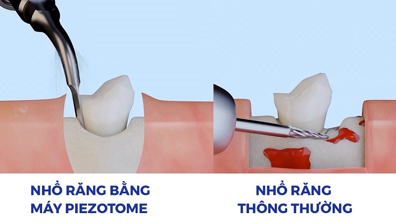 ưu điểm nhô răng bằng máy piezotome