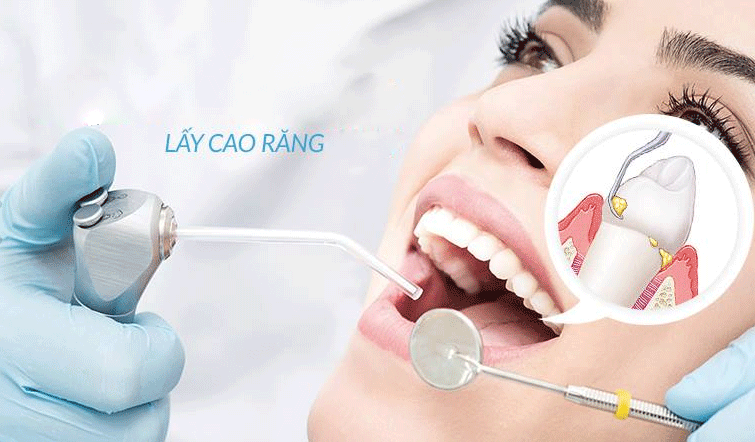 Lấy cao răng giá bao nhiêu tiền tại nha khoa Sea Dental