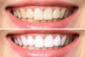 5 thói quen sai lầm khiến cho chân răng bị vàng và cách khắc phục