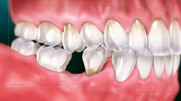 Những ảnh hưởng khi mất răng số 6