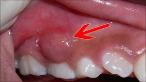 Nguyên nhân và cách điều trị khi bị áp xe răng