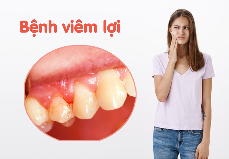 Nhiễm trùng nướu gây nên tình trạng viêm nha chu và sâu răng