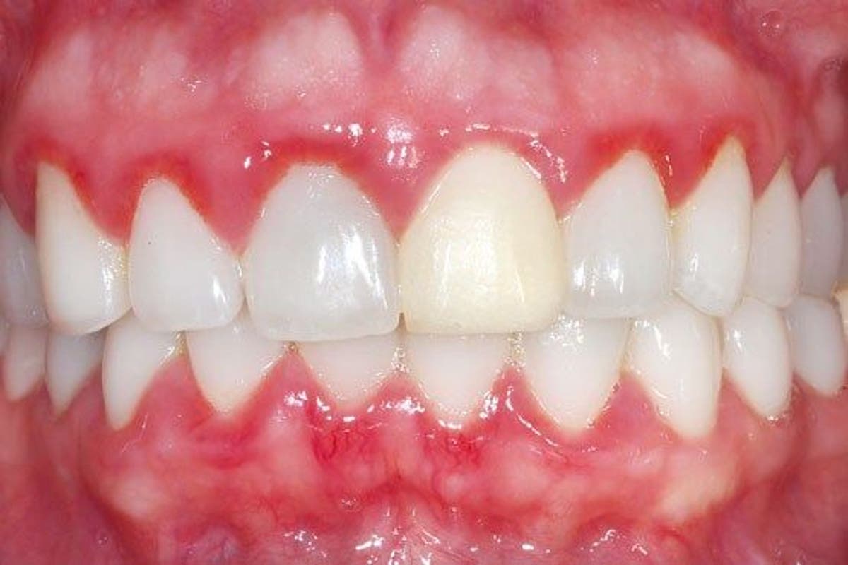 Viêm nướu răng gây ra bệnh nha chu