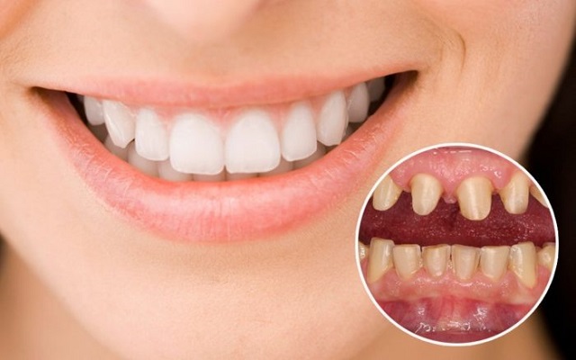 Bọc răng sứ cải thiện răng bị thưa