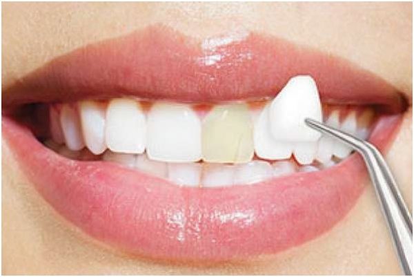 Thực hư về phương pháp bọc răng sứ không mài mà bạn cần biết