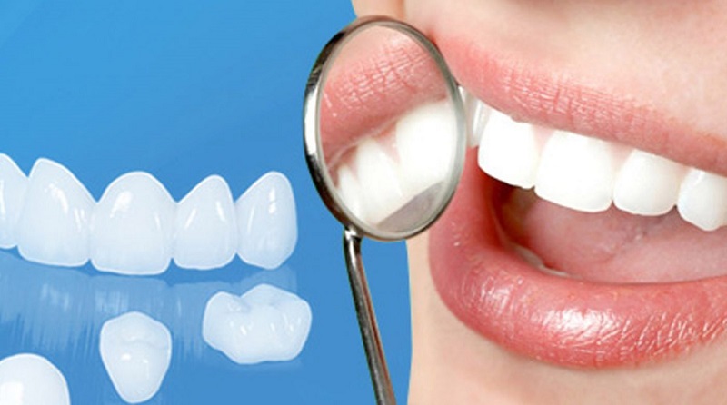 Bọc răng sứ giúp nụ cười bạn đẹp hơn