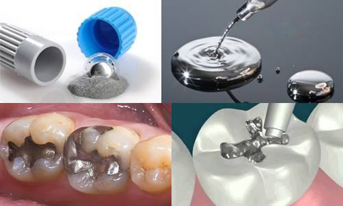 Trám răng bằng vật liệu Amalgam khá phổ biến hiện nay