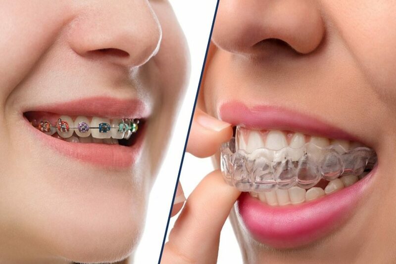 Phương pháp niềng răng bằng mắc cài và niềng răng trong suốt